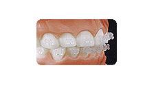 orthodontic-treatment42